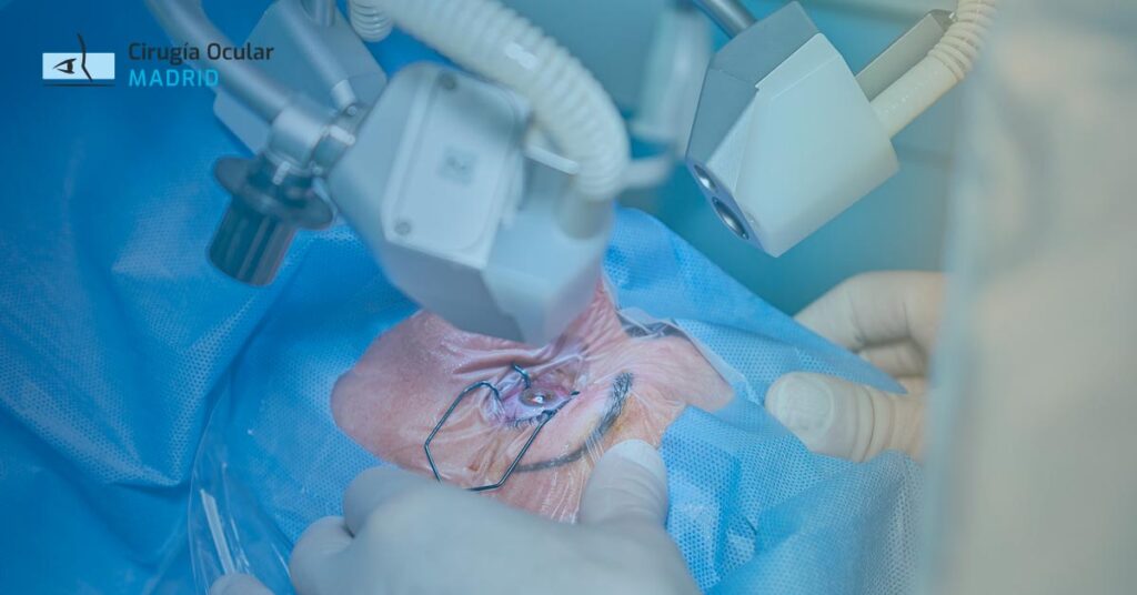 Cirugía refractiva: Desmantelando mitos, descubriendo riesgos y revelando efectos secundarios ocultos