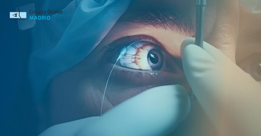 Cirugía LASIK: Procedimiento, Ventajas y Preguntas Frecuentes