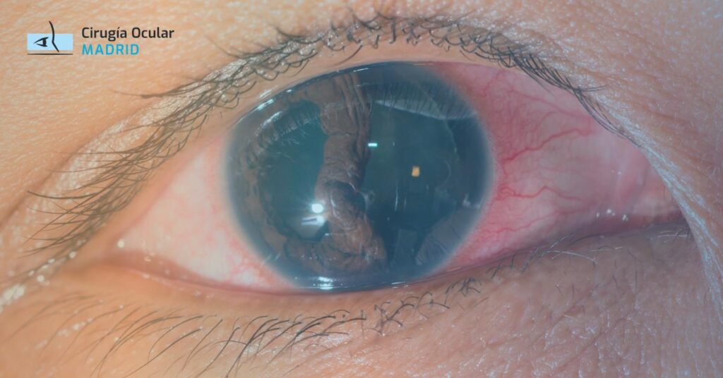 Postoperatorio de desprendimiento de retina: cuidados esenciales y recomendaciones