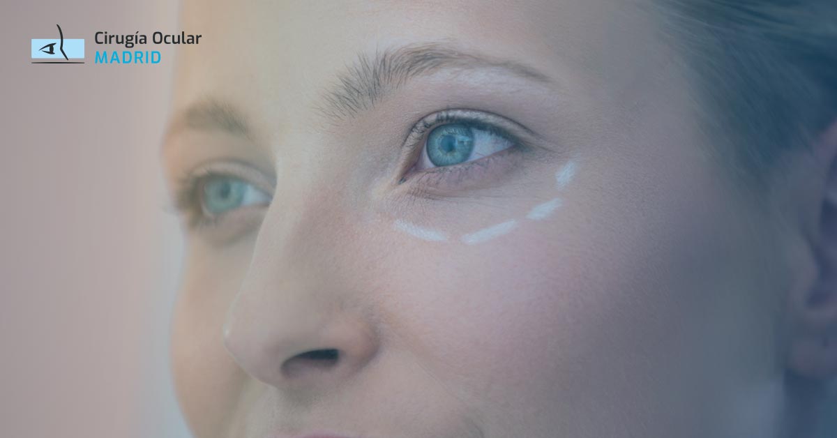 ¿Por qué tenemos ojeras? Causas ocultas y cómo reducirlas