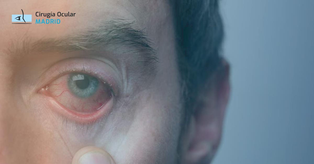 Conjuntivitis bacteriana: Cómo tratarla, prevenirla y diagnosticarla
