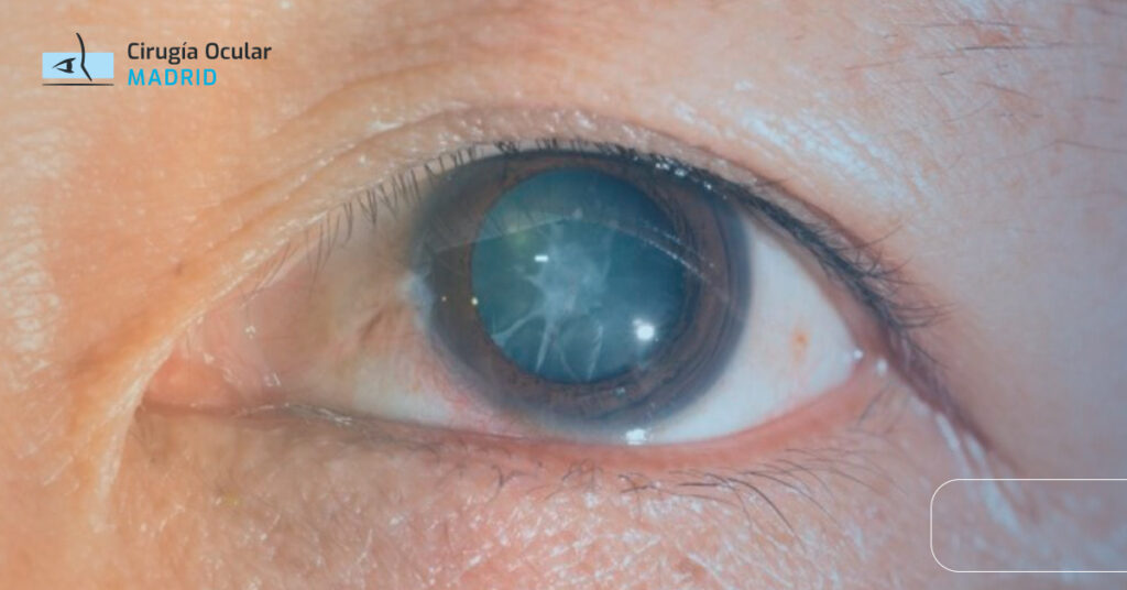 Tipos de cataratas y su tratamiento