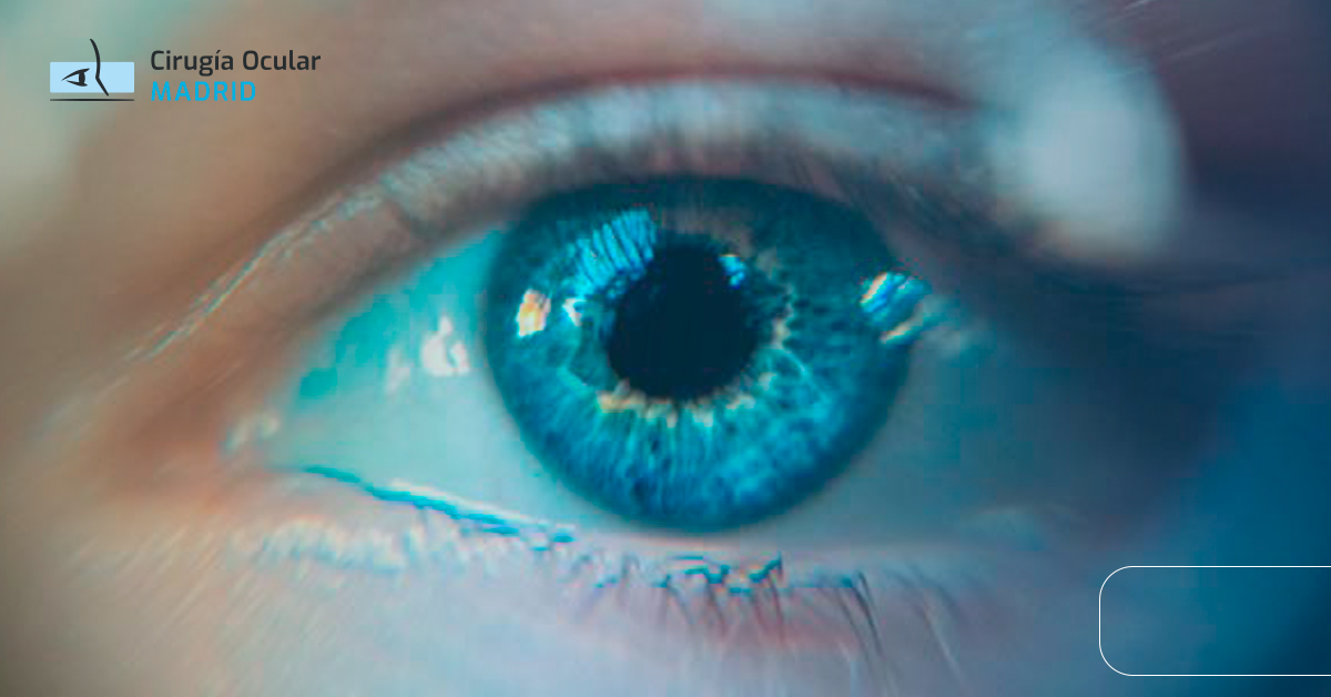 Miodesopsias o moscas volantes: ¿qué son y cuándo tratar?