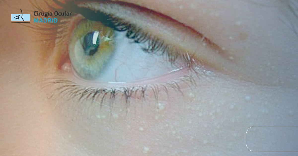 Xantelasma en los párpados: causas y cómo eliminarlo