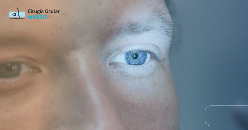 Ojos Llorosos: Causas, Síntomas y Tratamiento Especializado