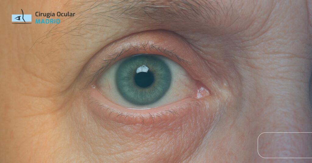 Arco Senil: Causas, Síntomas y Relación con Colesterol