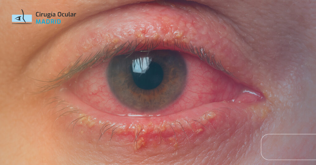 Ojo con blefaro conjuntivitis