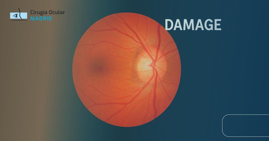 Nervio Óptico Dañado: Síntomas y Tratamiento