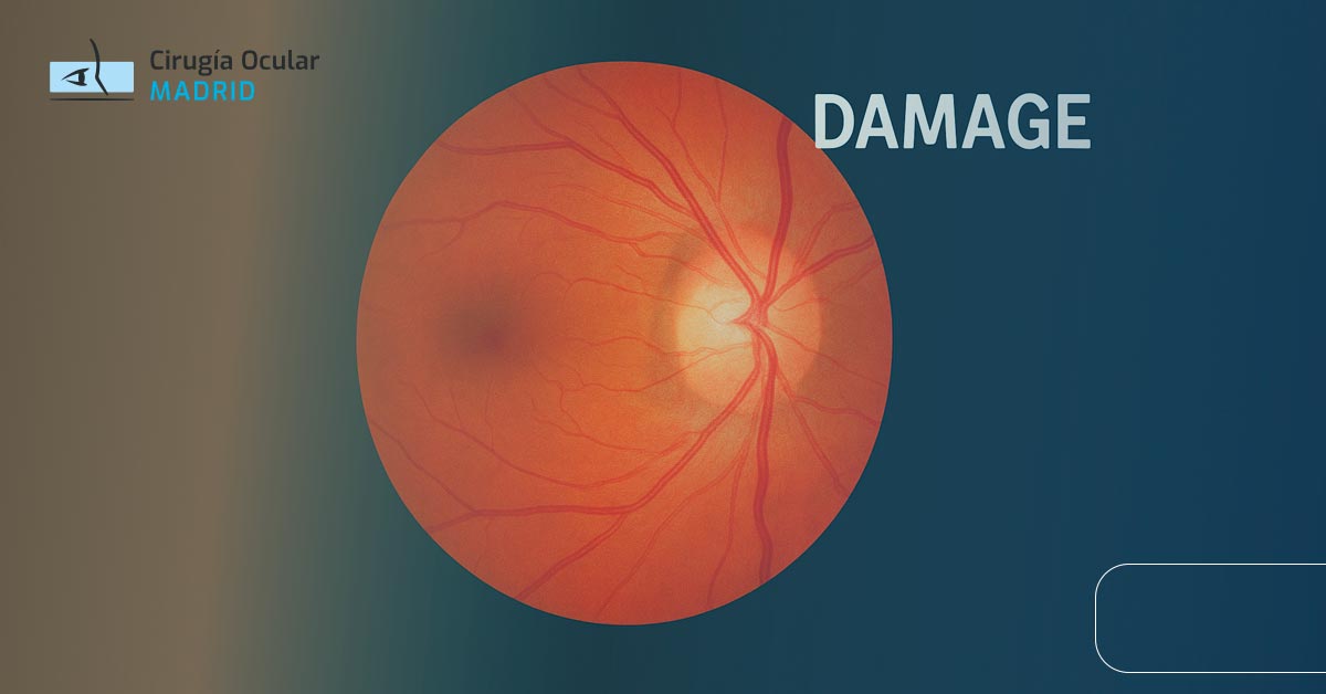 Nervio Óptico Dañado: Síntomas y Tratamiento