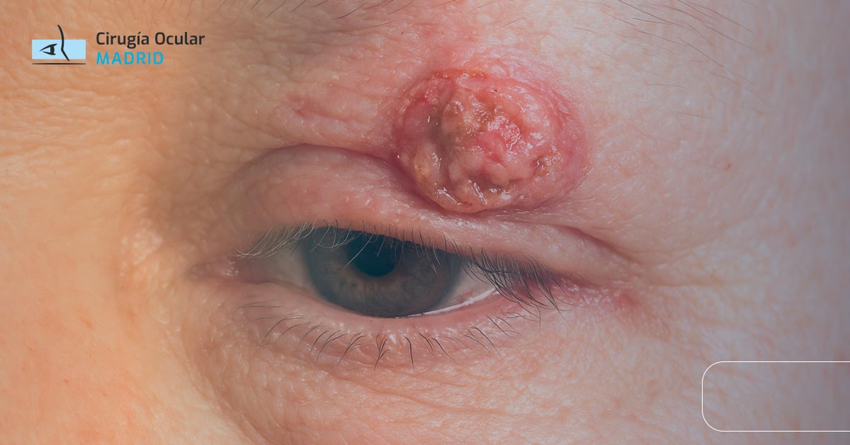 Cáncer de Párpado: Causas, Síntomas y Tratamiento
