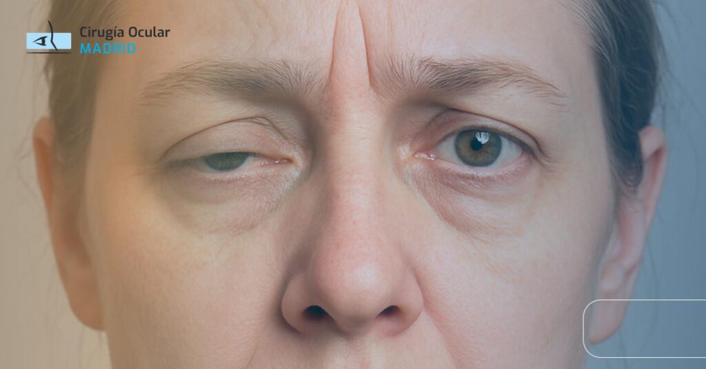 Miastenia Ocular: ¿Qué es y Cómo es el Tratamiento?