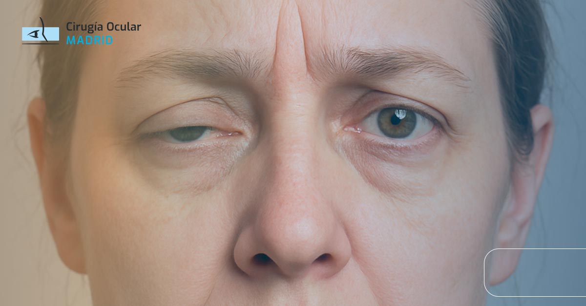 Miastenia Ocular: ¿Qué es y Cómo es el Tratamiento?