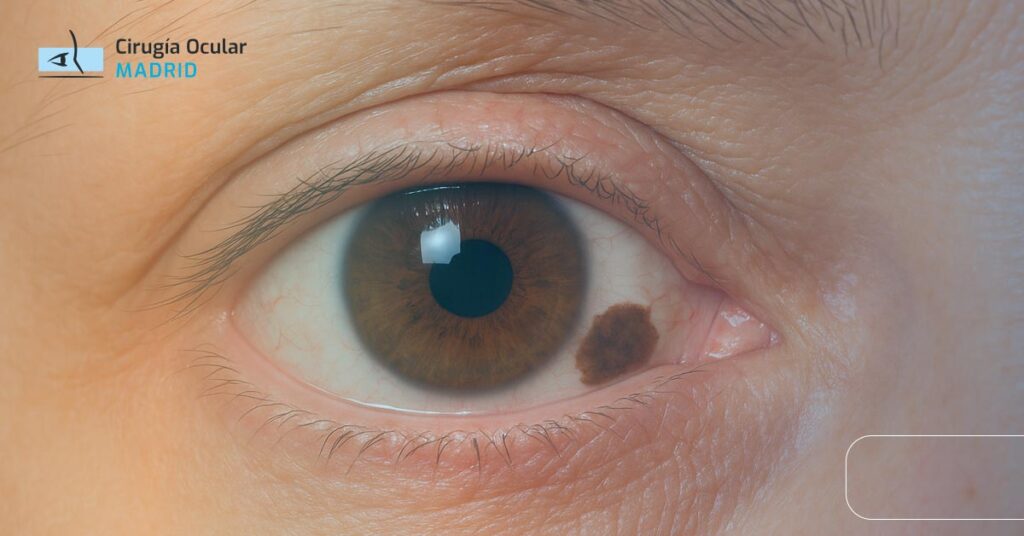 Mancha Marrón en el Ojo: Causas y Tratamiento