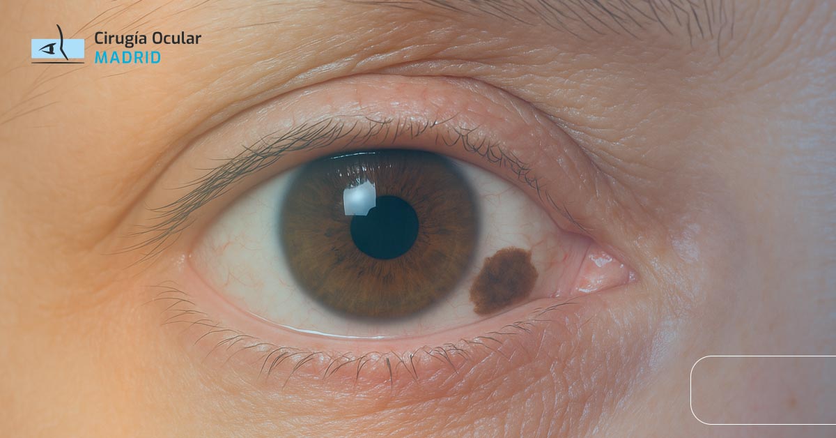 Mancha Marrón en el Ojo: Causas y Tratamiento
