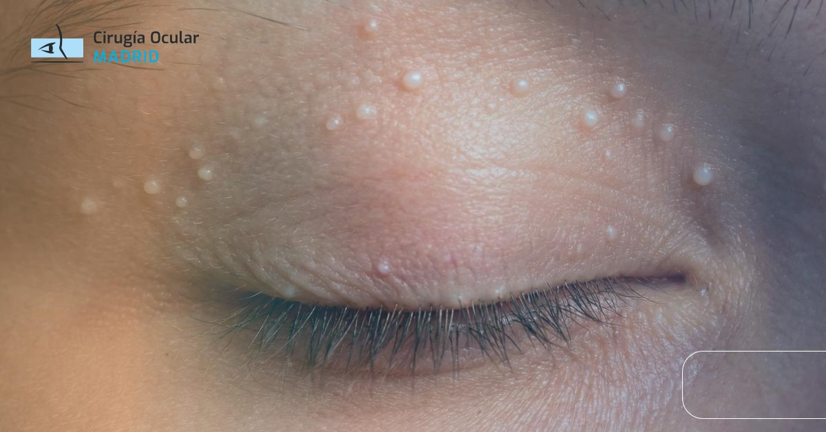 Granitos en el Párpado: Causas y Tratamiento