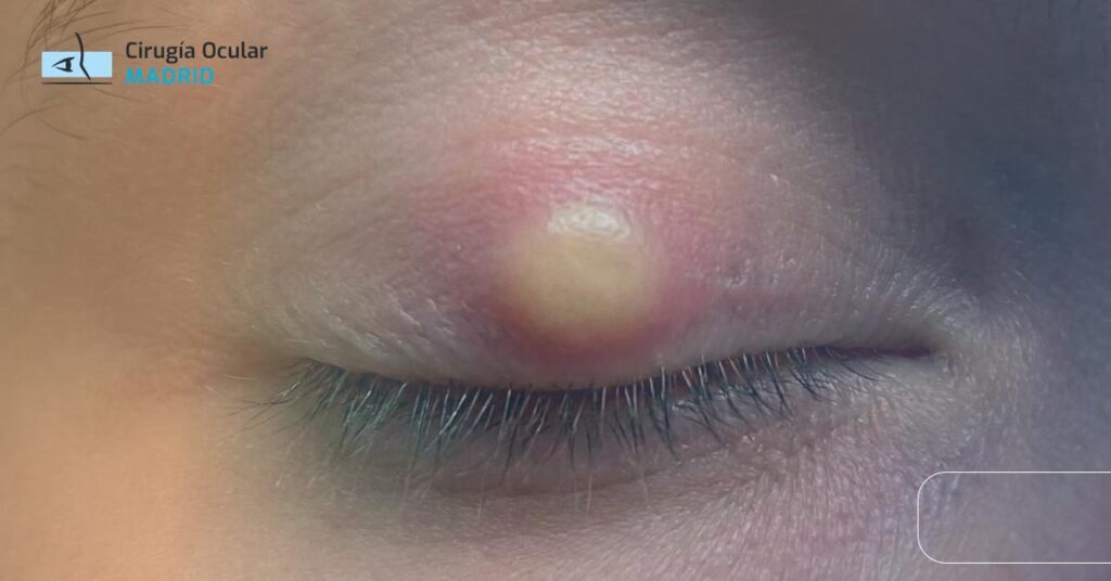 Bolita de grasa en el ojo: causas, tipos y tratamiento