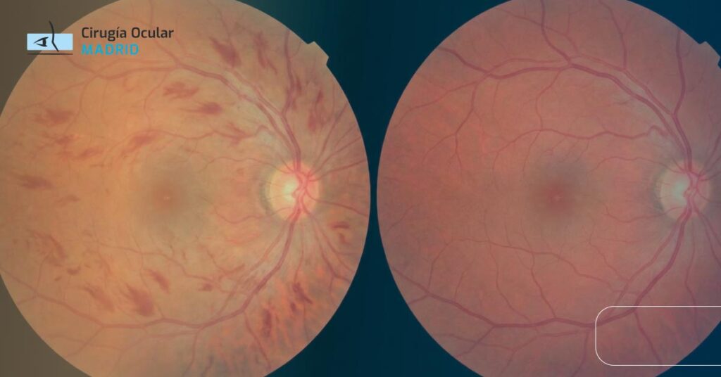 Trombosis Ocular: ¿Se Recupera la Vista?