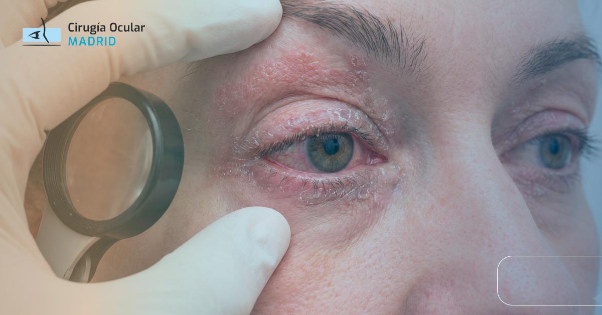 Psoriasis en los ojos: síntomas y tratamiento